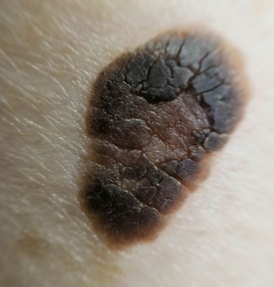 90后已经在长"老年斑"的路上了!就问你怕不怕