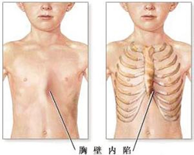 3岁半的宝宝,患上"鸡胸",全因妈妈平时没给他吃这东西!