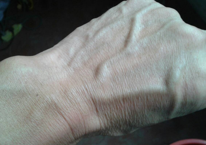 身体上青筋凸起是怎么回事?出现这些症状时,就要注意了