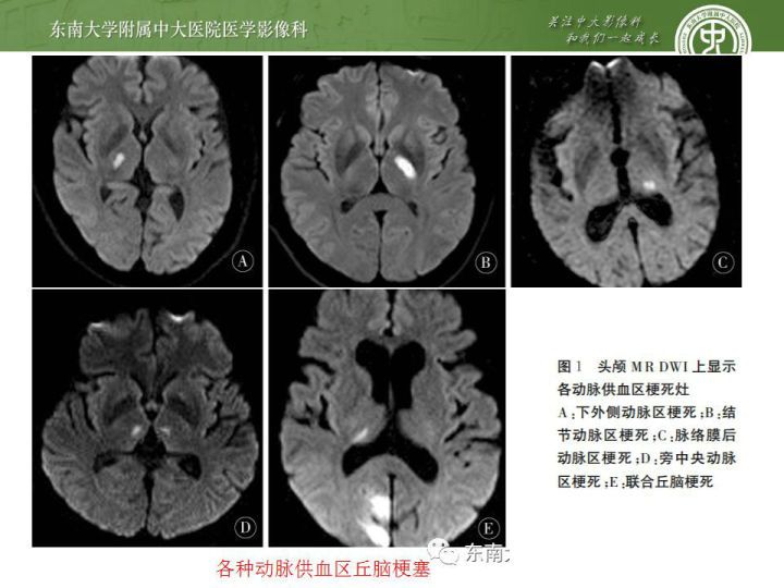 解剖 頭部血管解剖及willis環常見變異