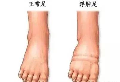 肾病出现水肿,医生提醒:喝水一定要注意!
