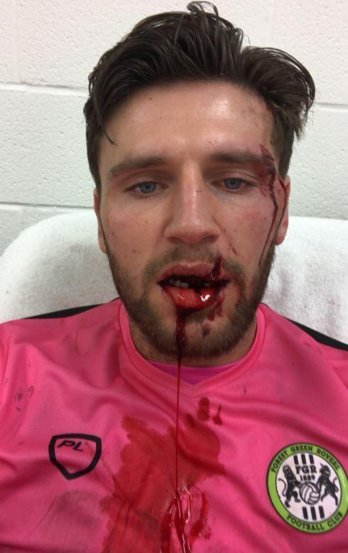 球员面部被踹满嘴是血,呼吁球迷资助他补牙