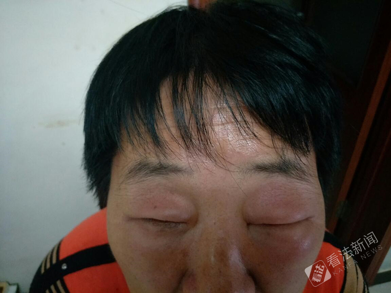 北京市民地摊上免费染发致皮肤过敏 双眼红肿难睁开