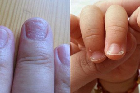 谈谈儿童手指甲凹凸不平 不注意后果严重