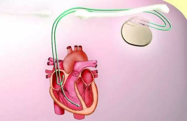 三甲醫院主任教您如何選擇永久心臟起搏器?面對起搏器不再迷茫!