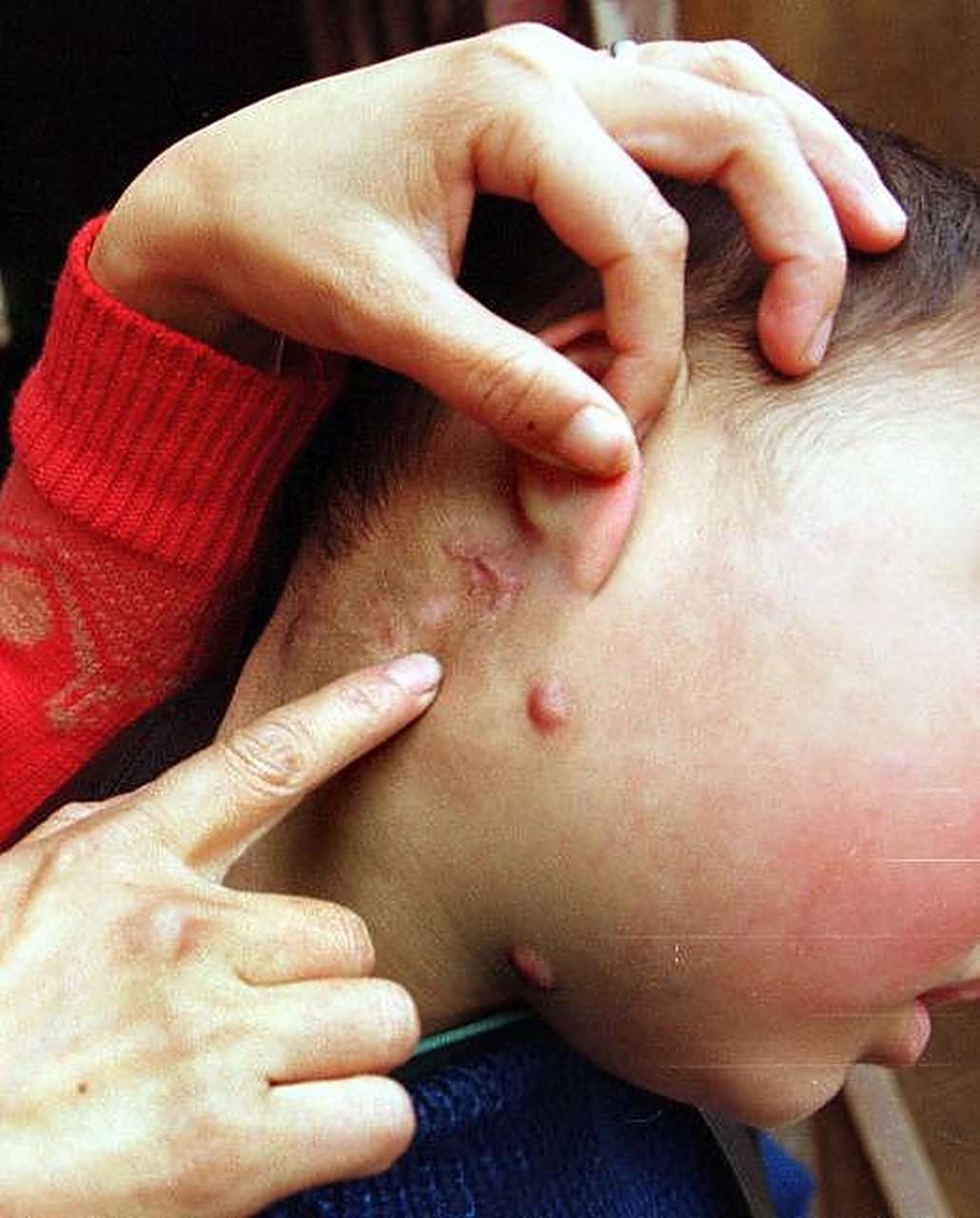 恶性淋巴瘤的主要症状 1.