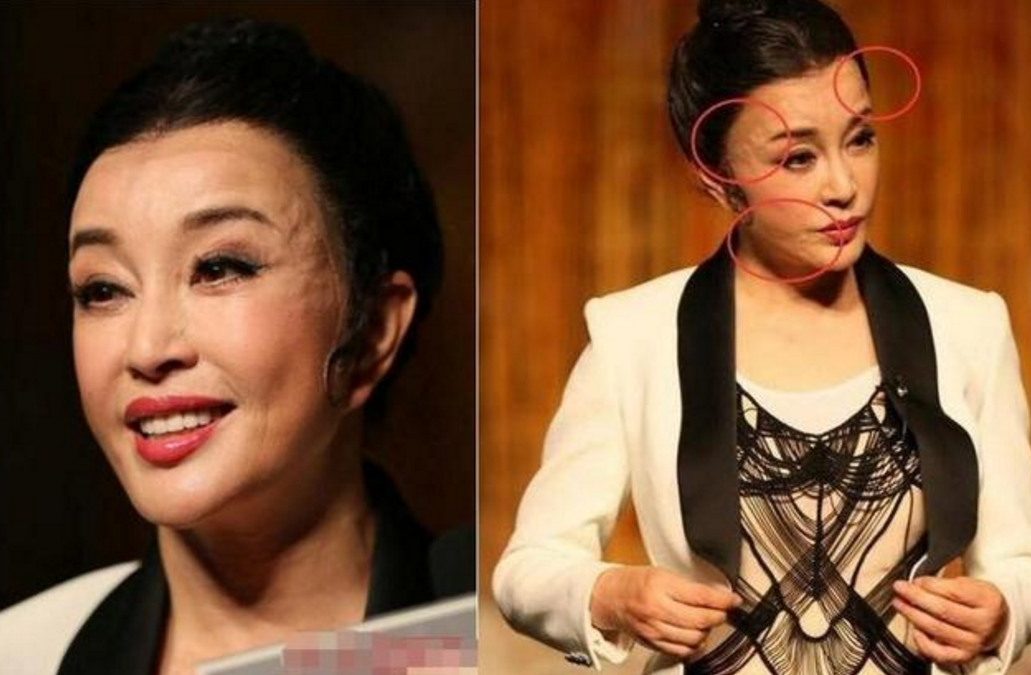 被玻尿酸毁了的明星,张檬老10岁,李小璐变网红,她像换了一张脸