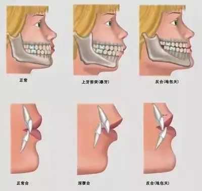 科普 | 错颌畸形的最佳矫正时机