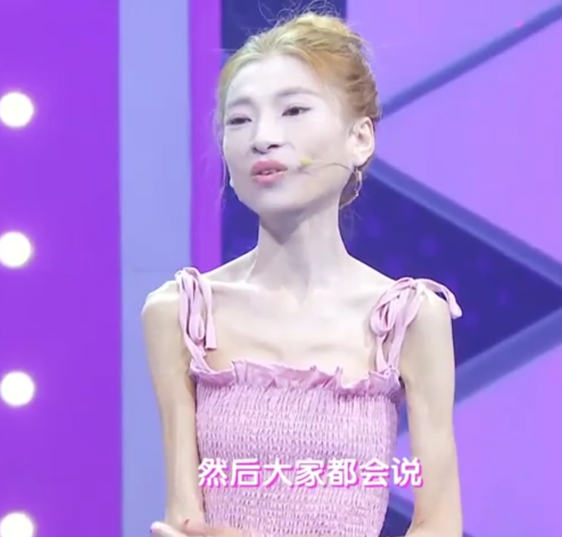 女孩为爱瘦70斤成骷髅妹,上街回头率高,对于质疑回应
