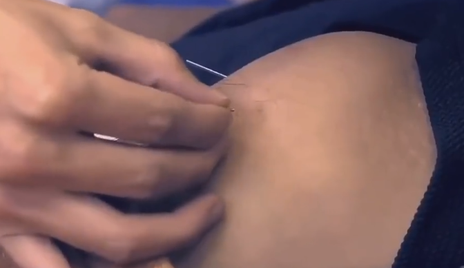 肖战旧视频被扒,练舞蹈膝盖上扎银针,痛到冷汗直流!