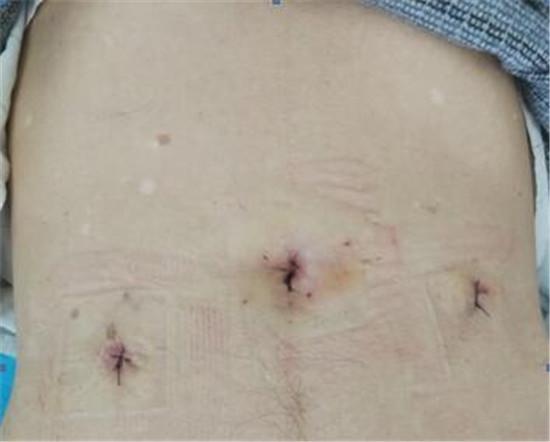 八旬老人腹股沟包块疼痛不适,医生三个小孔解决问题