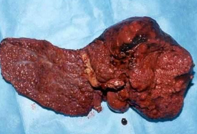 为什么肝癌被称为"癌王"?看完后我想通了