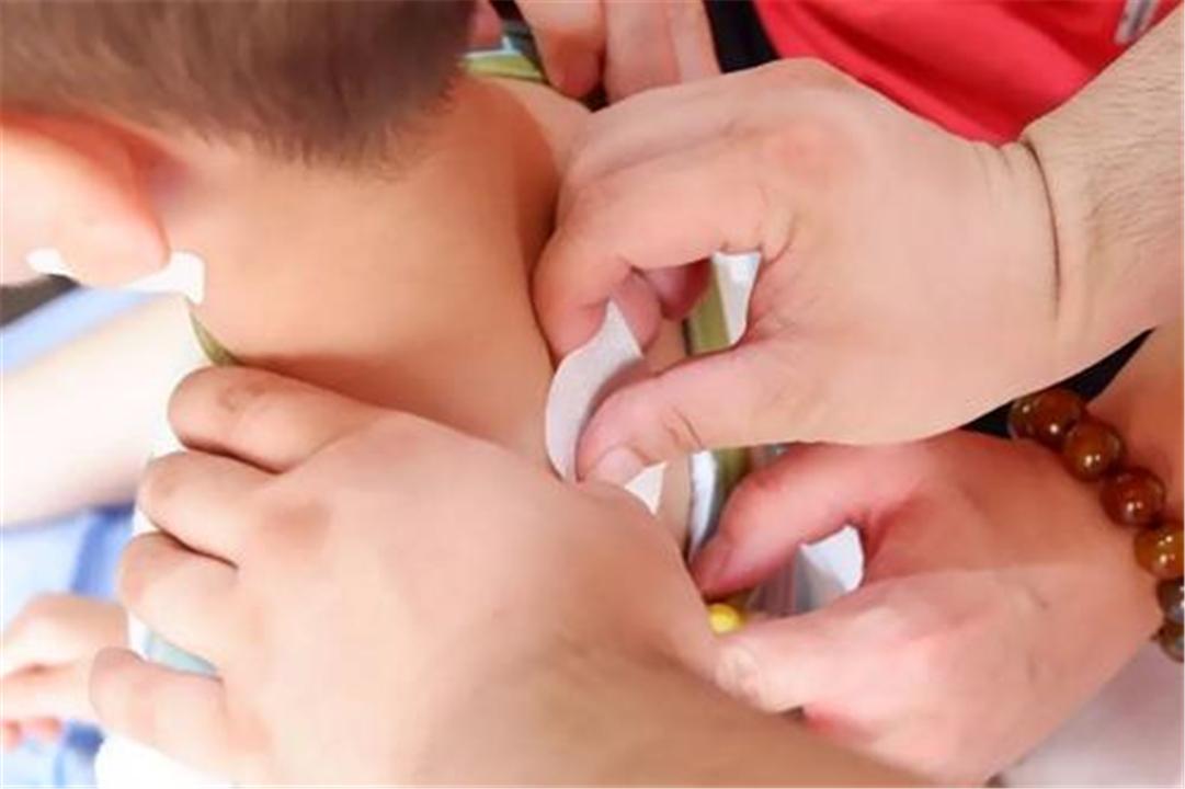 你还在给孩子贴"三伏贴"吗?这些危害,家长要早知道
