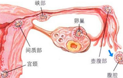 输卵管问题,如何缩短怀孕的等待时间?
