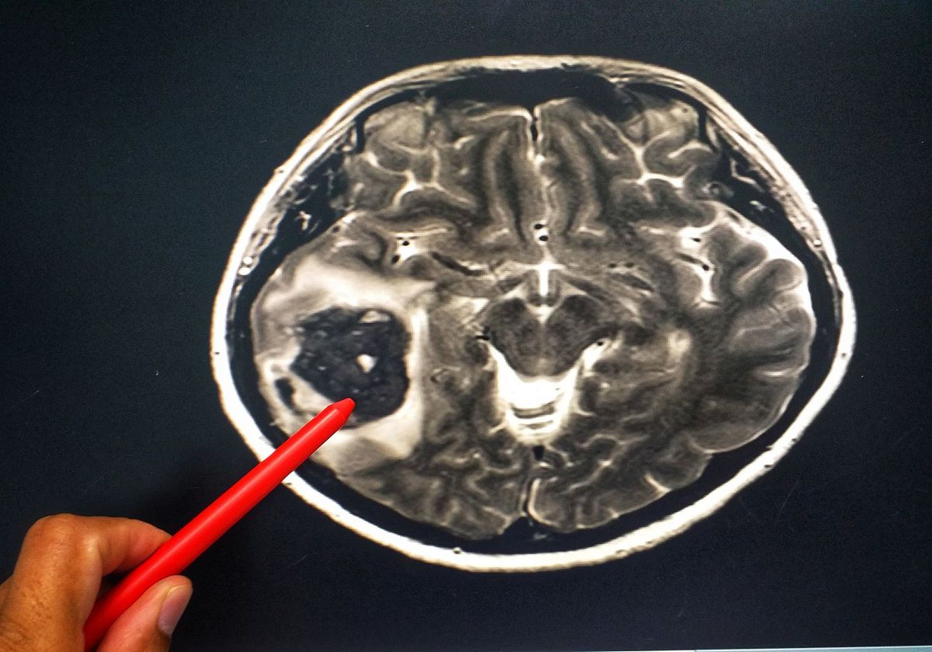 脑白质脱髓鞘改变怎么治疗?