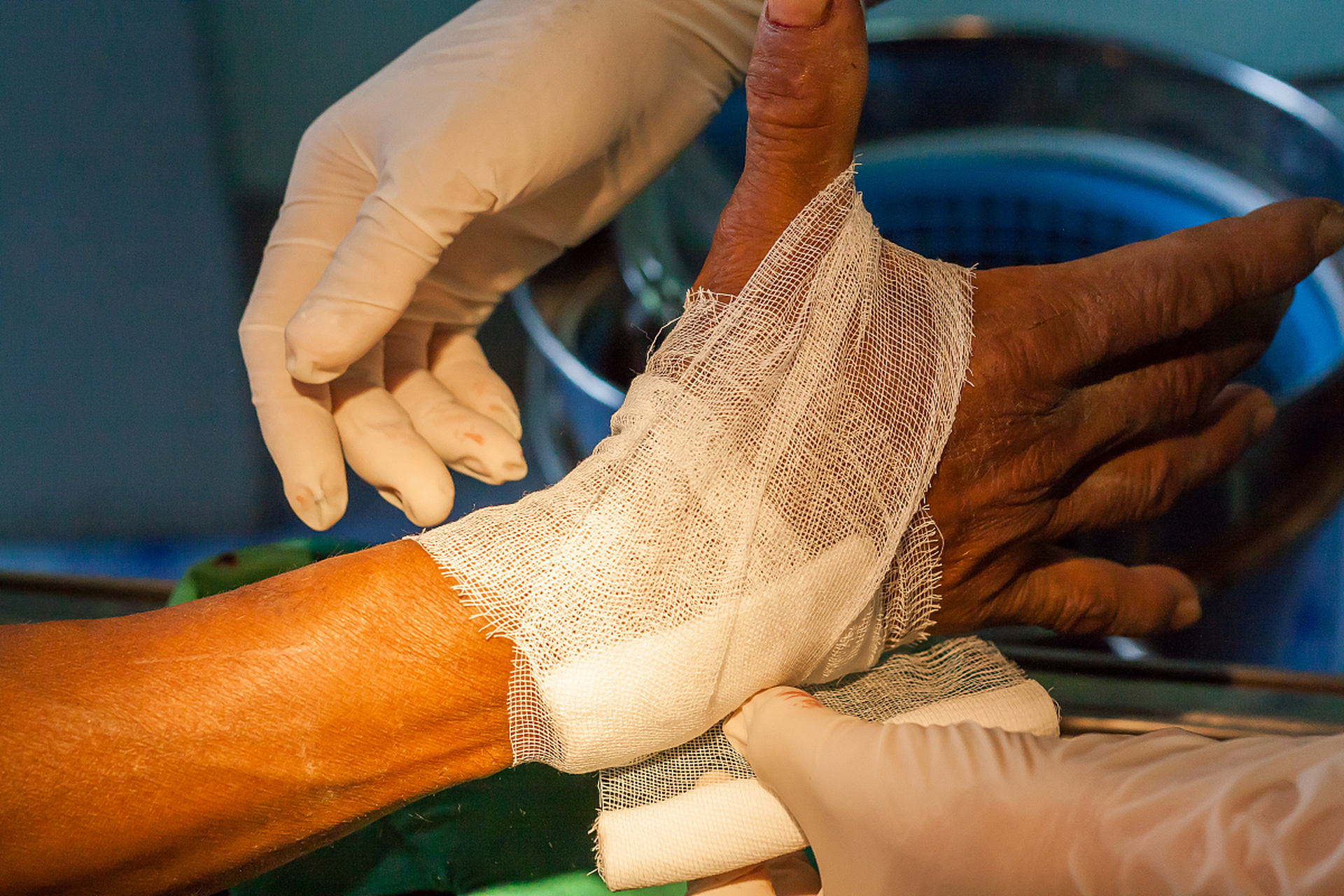 掌腱膜挛缩最佳治疗方法是什么?