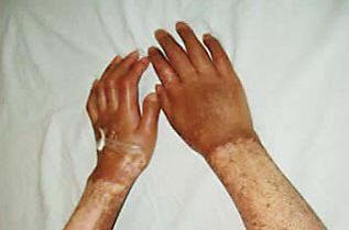 硬皮病不光是皮肤病,还可引起身体多系统损害