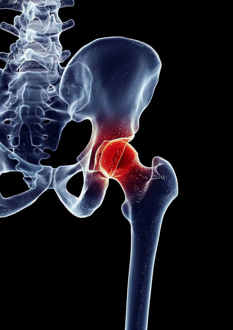 方法选对,可达到良好的治疗效果  股骨头坏死是非常常见的骨科疾病之