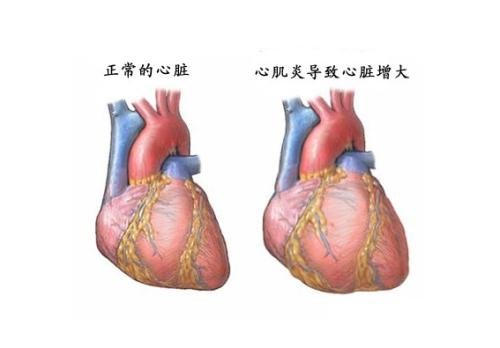 治疗暴发性心肌炎 "中国方案"引发业界关注