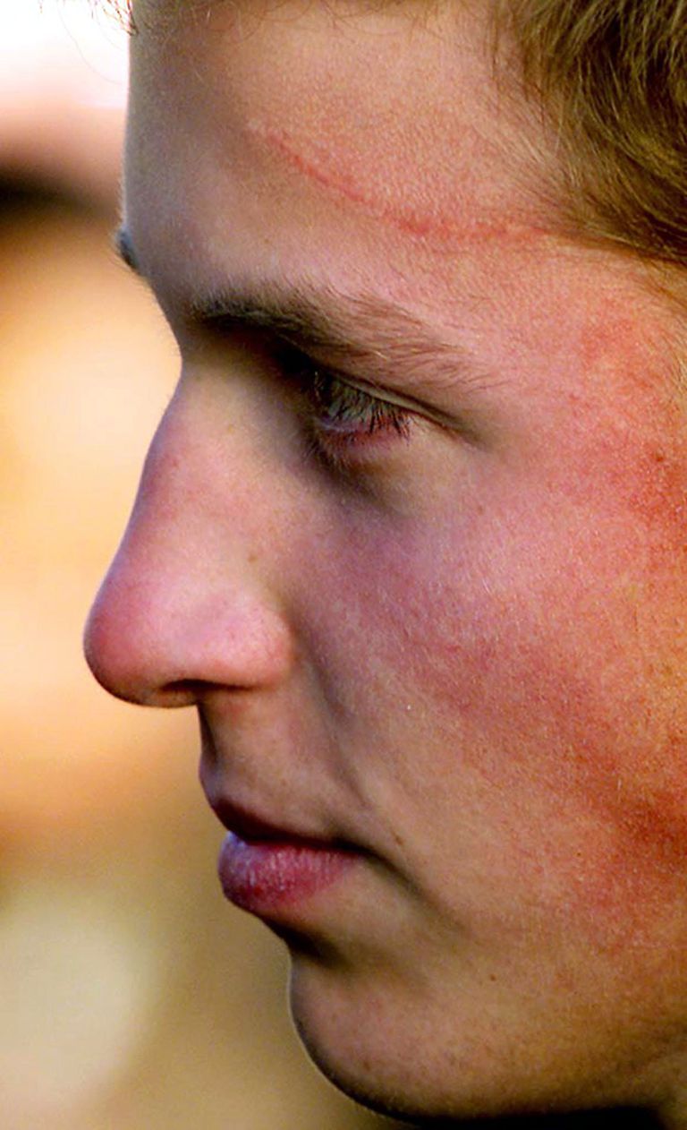 威廉王子的额头上有道伤疤?伤疤背后的故事还很疯狂