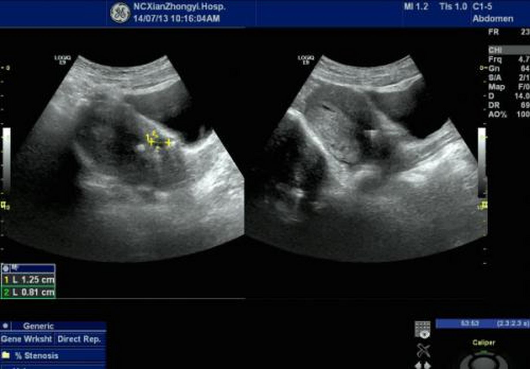 科普知识竞赛#美克尔憩室是胚胎肠系膜管的先天性残余,常位于回肠