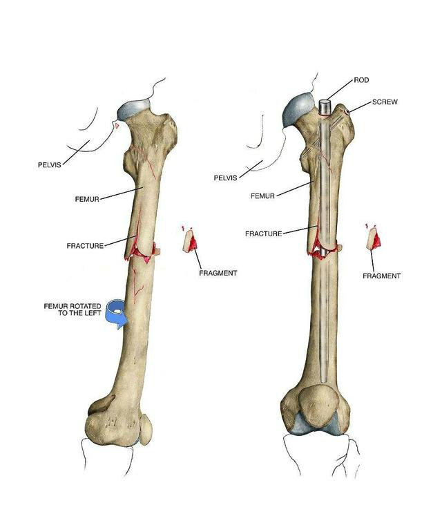 股骨骨折手术后,术后能恢复到什么样?