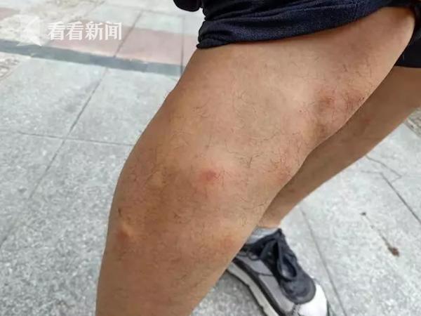 四五十个疙瘩!男子住酒店一夜双腿肿成这样 负责人:他运气不好