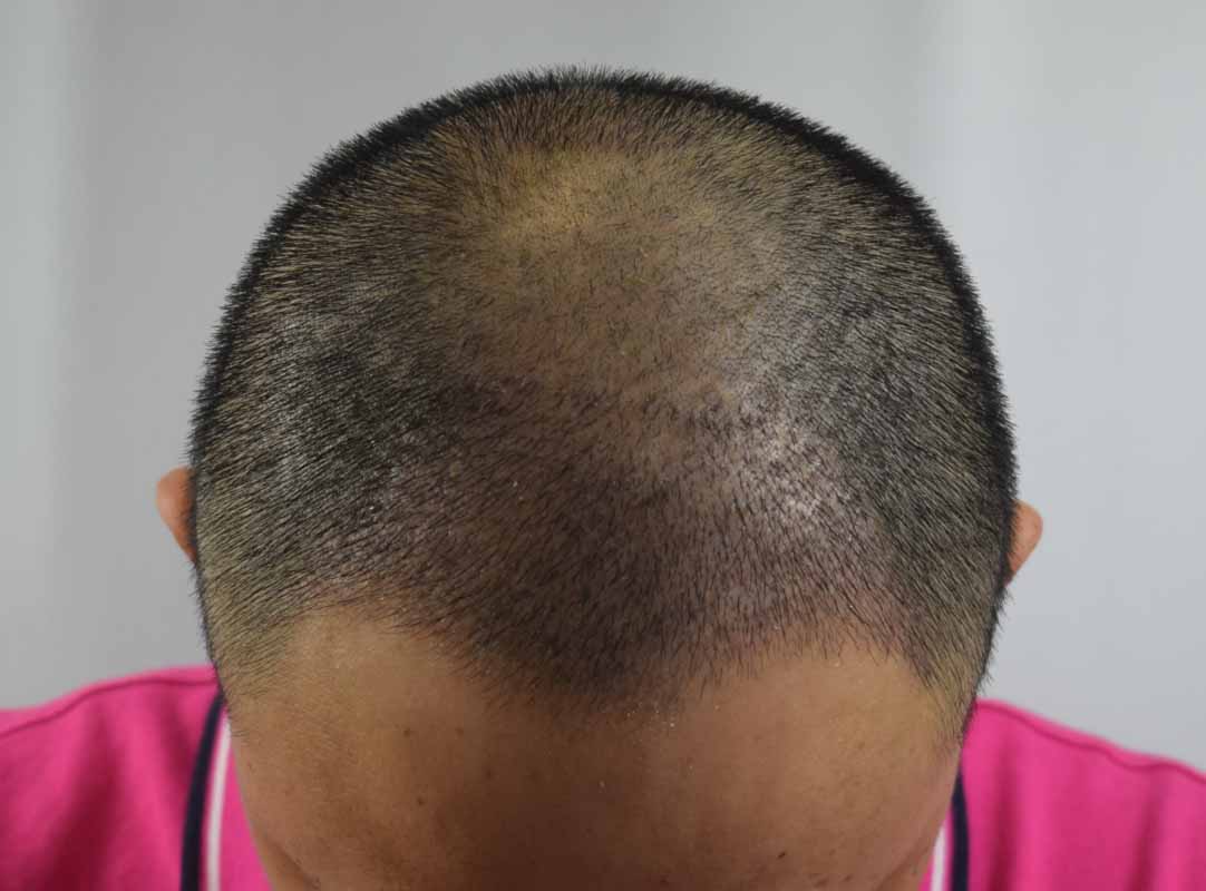 喝醉了植发(植发后喝酒对头发有什么影响)