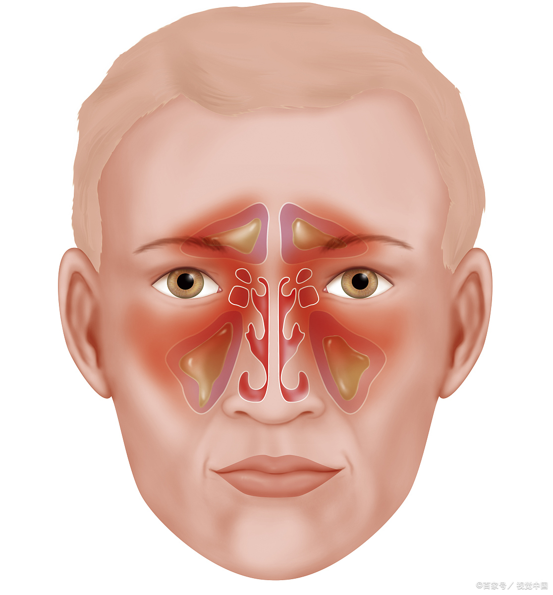双侧筛窦炎严重吗?