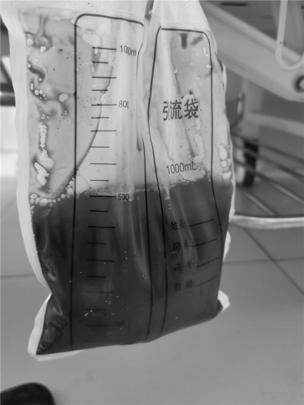 长沙6旬老人剧烈运动后竟排出500毫升鲜血尿