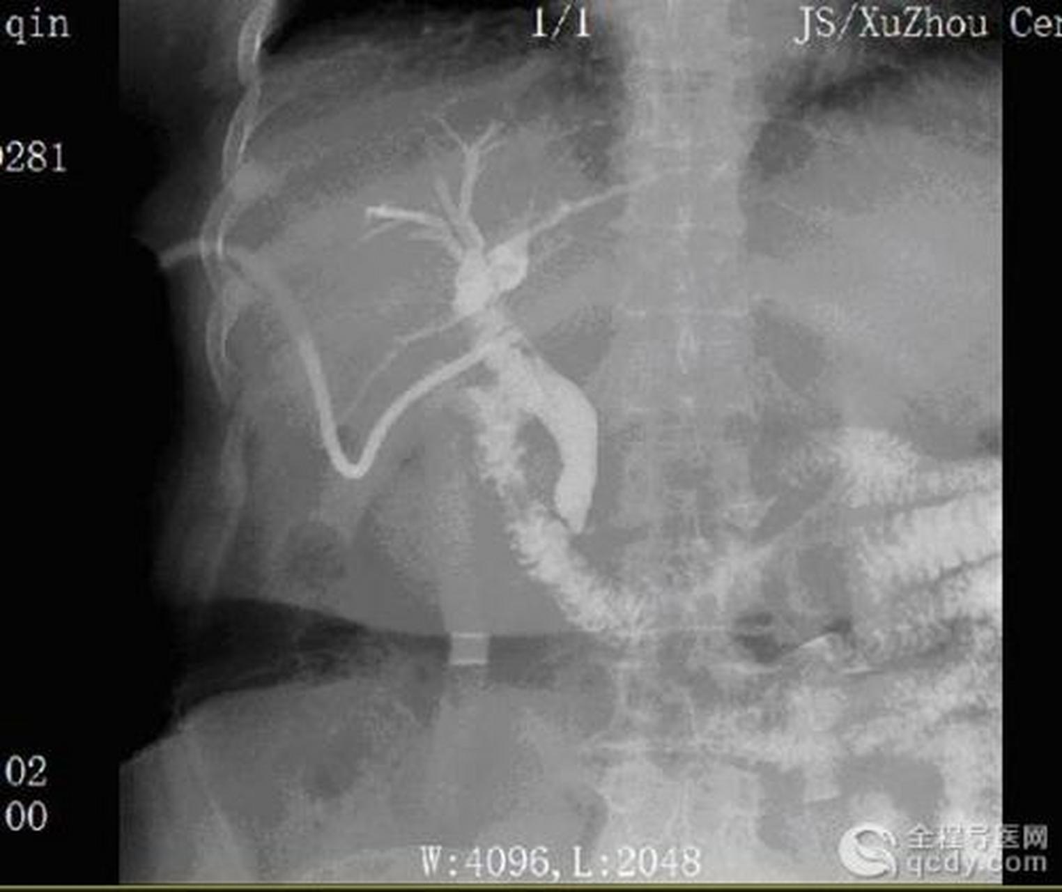 科普知识竞赛#"t"形管胆道造影是手术后检查胆道的一种常用的x线检查