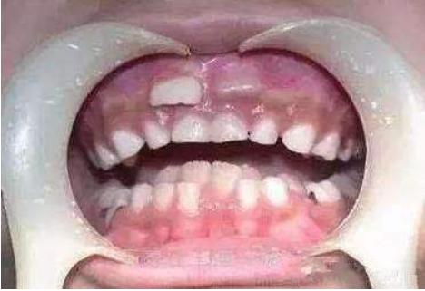 儿童鲨鱼牙齿图片图片