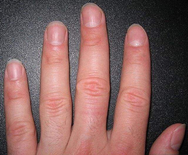 尿毒症手指甲图片图片
