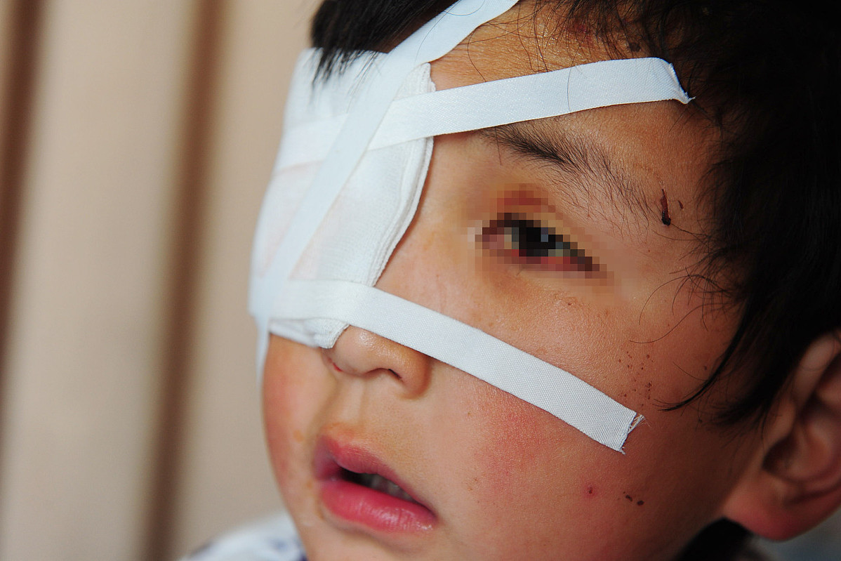 4岁女孩因玩铅笔不幸戳伤左眼.@武汉爱尔冯梅的动态