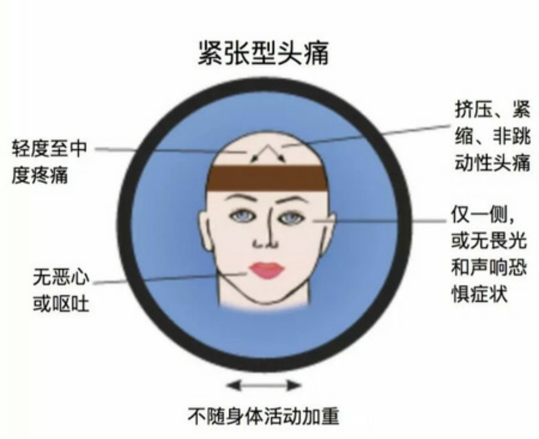 緊張性頭痛的中醫針刺治療方法