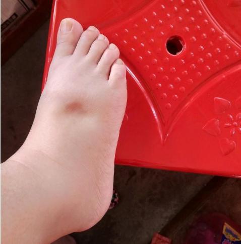 血糖高的人,身体3个表现,若占1个,可能肾脏受损