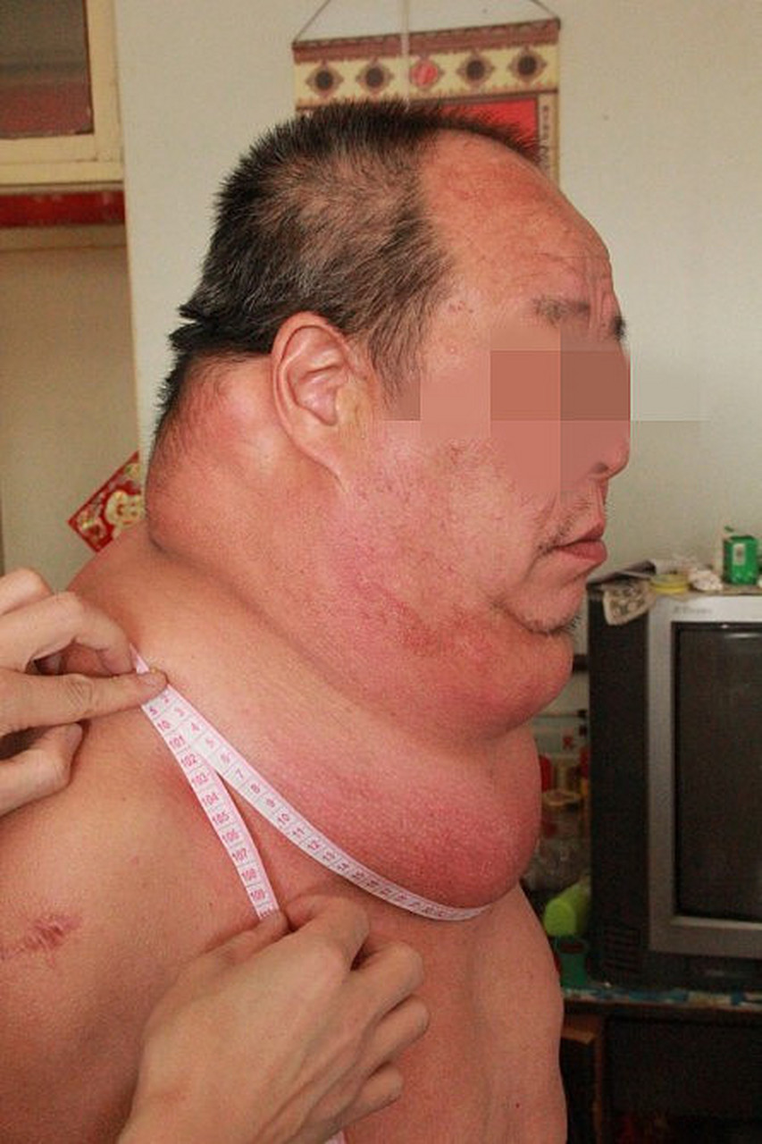 甲状腺结节钙化严重吗?粉丝们的说法众说纷纭.