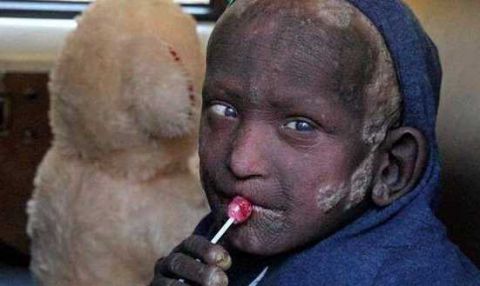 印度男孩患怪病,即将变成"石头",全球得此病者不到十人!