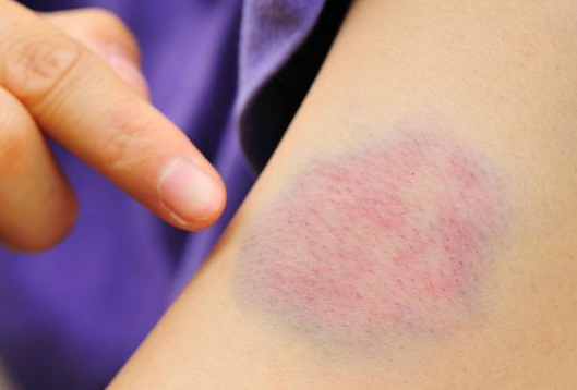 如果不幸得了白血病后皮肤上会有这个信号,你注意到了么?