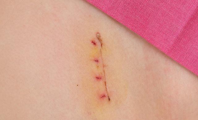 女人剖腹产,横切好还是竖切对身体好?各位准妈妈一起看看吧