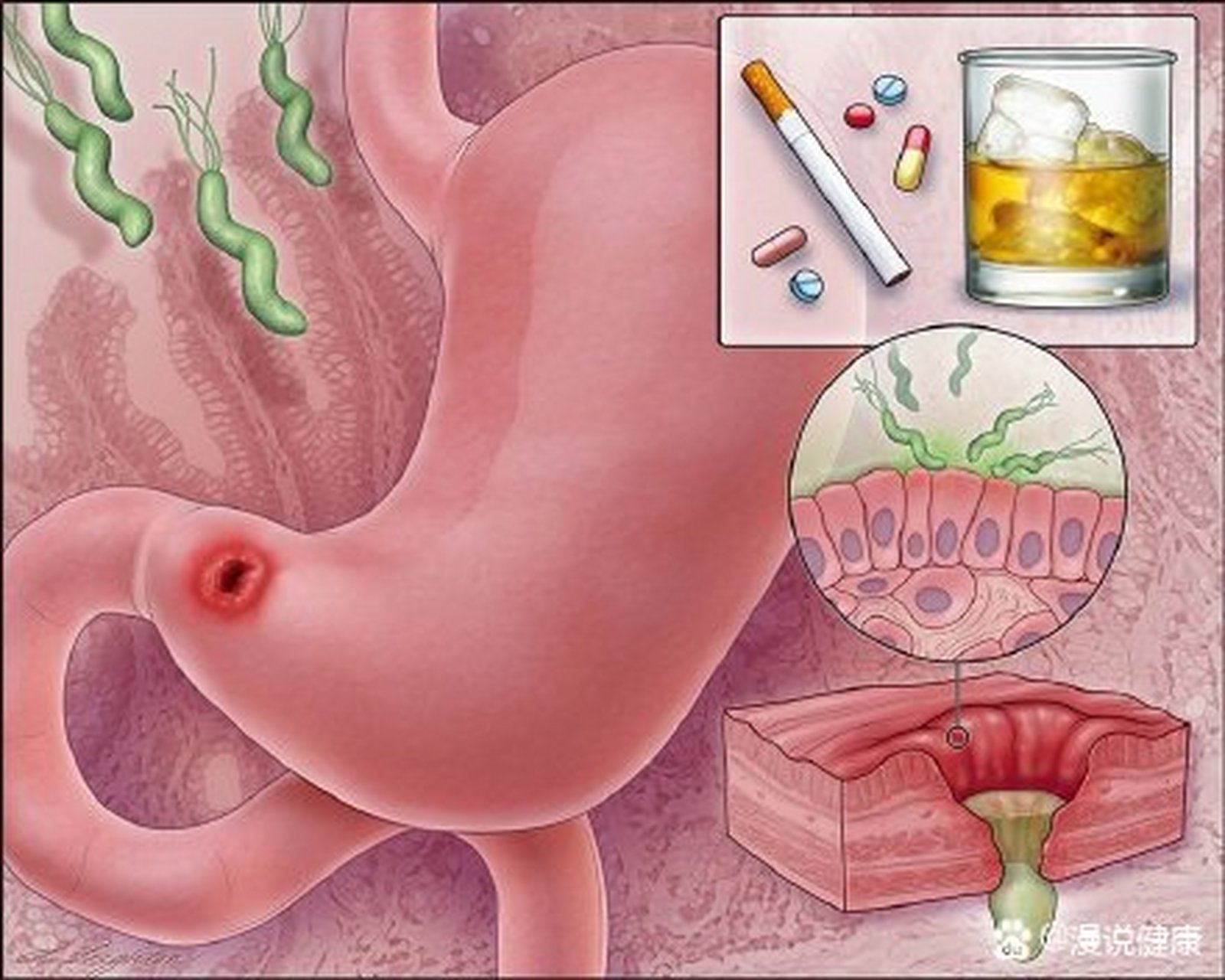 消化性溃疡病因图片