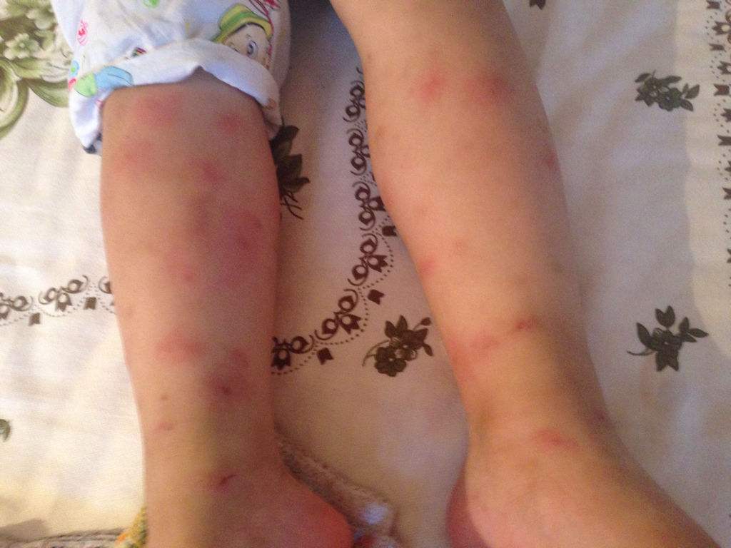 蚊虫叮咬怎么办教你几招快速解决孩子痒,红肿问题