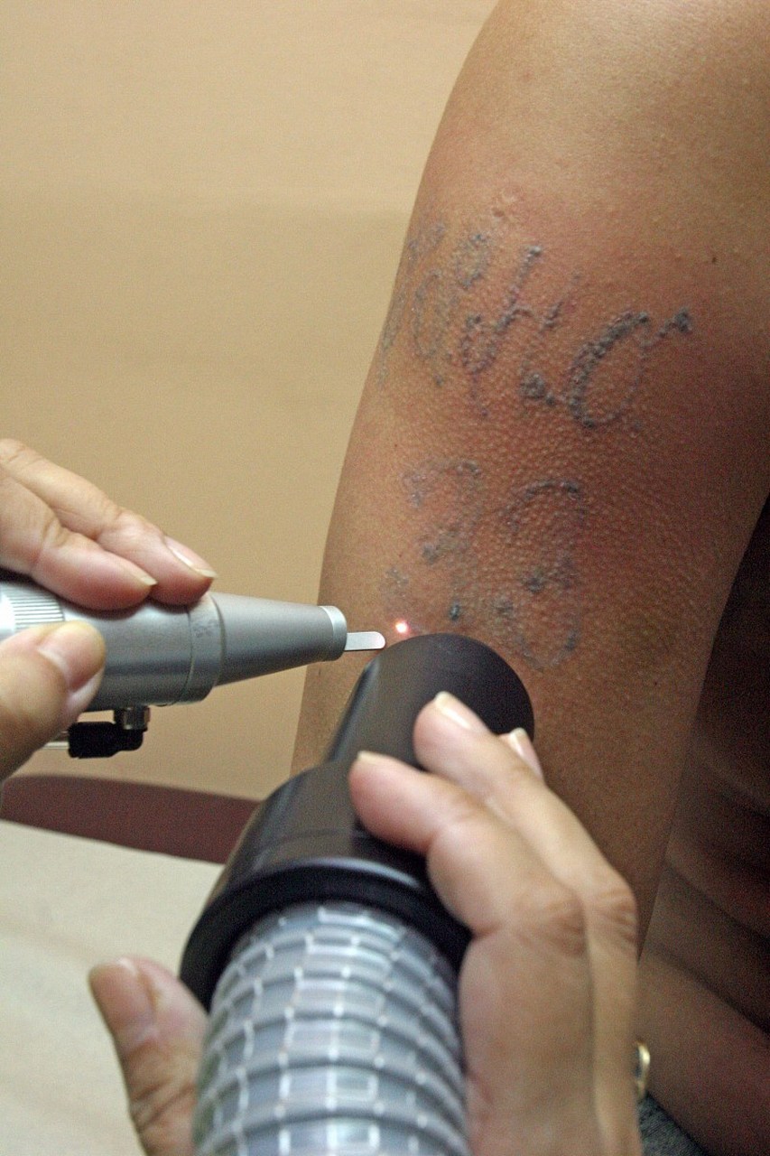 纹身怎么才能彻底洗掉 #激光去纹身#   纹身是将色素注入皮肤中,形成