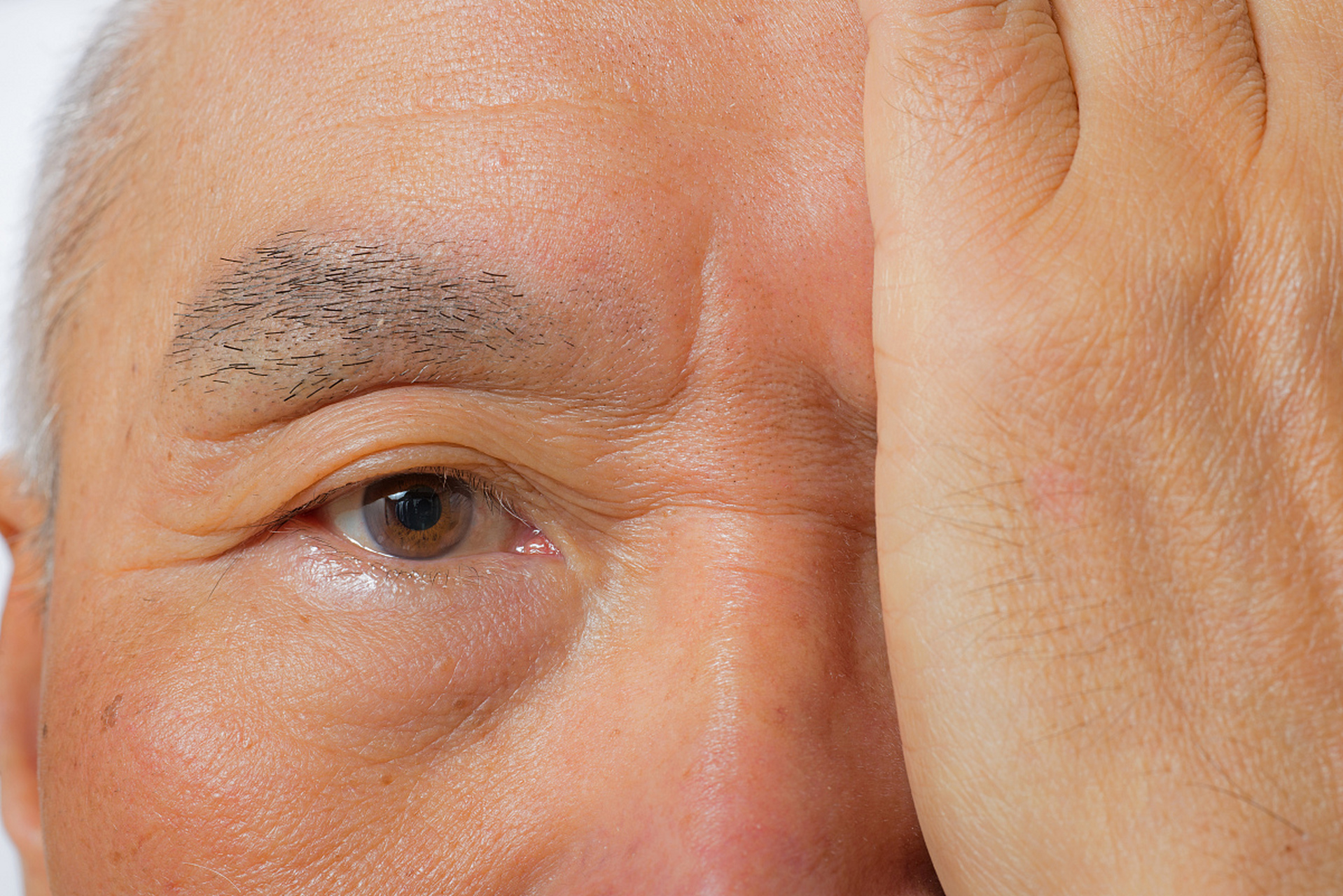 悬针纹用什么去除效果最好的 #医美#   悬针纹是指两眉中间出现的竖纹