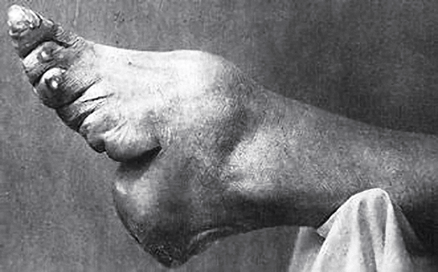 寸金莲,可见女性的脚已经完全变形,脚趾已经紧贴着脚底,就连骨头都