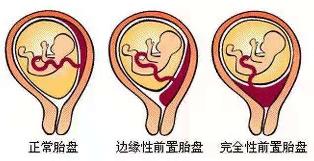 怀孕胎儿位置在前壁和后壁有什么不同吗?这几点区别很