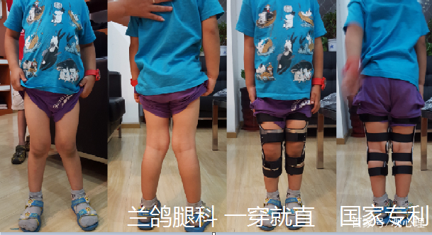 矫正o型腿
