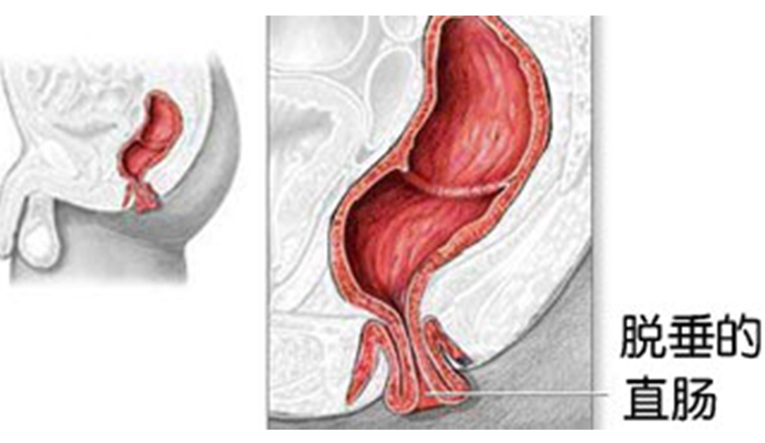 脱肛和痔疮的区别,注意区分!