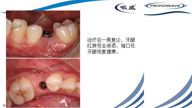 病例分享丨种植体周围龈瘘管一例