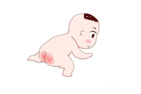 红屁屁的原因及预防方法,知道这些轻松搞定红屁股!